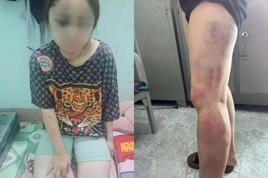 Xác minh thông tin người phụ nữ bị chồng hờ bạo hành dã man