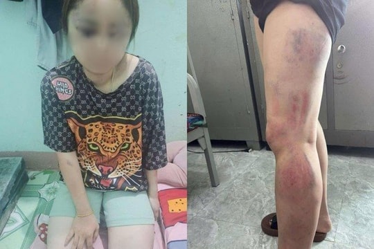Công an vào cuộc điều tra vụ người phụ nữ tố bị "chồng hờ" bạo hành