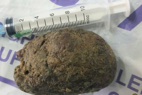 Người đàn ông phải phẫu thuật mở dạ dày do ăn quả hồng ngâm