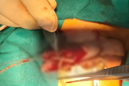 Bé trai bị chó nhà cắn đứt niệu đạo khi đang chơi đùa