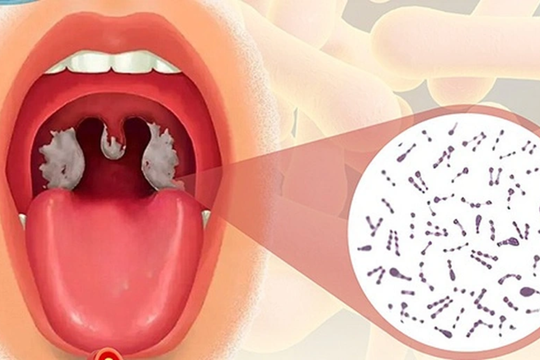 Bộ Y tế yêu cầu xử lý triệt để ổ dịch bạch hầu