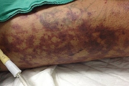 Người đàn ông ở Huế nhiễm liên cầu lợn sau khi ăn cơm thịt luộc ở quán