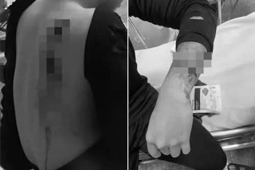 Nam sinh lớp 10 bị chém đứt gân tay trên đường từ sân bóng về nhà