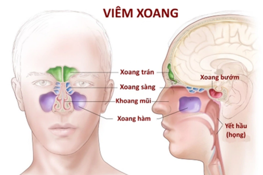 Loại bỏ viêm xoang hàm nhờ sử dụng xịt mũi họng Khiết Thanh