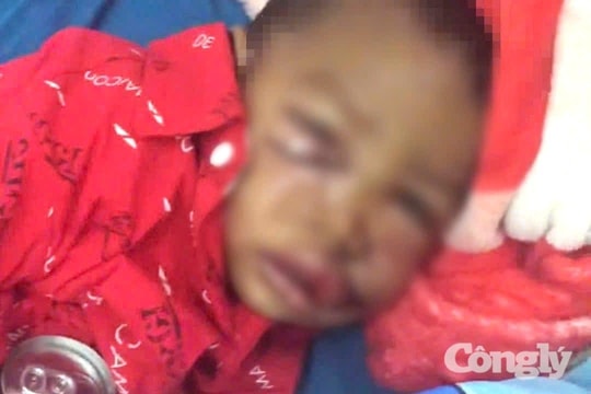 Cháu bé 2 tuổi bị chó hoang tấn công, cắn vào mặt phải nhập viện