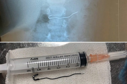 Bé trai 25 tháng tuổi nuốt phải kim băng nhọn gần 6cm