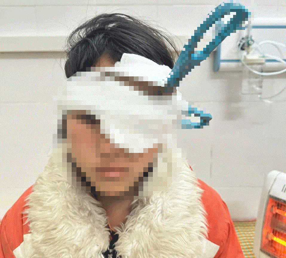 Đang vui chơi, bé gái 13 tuổi bị kéo đâm vào mắt