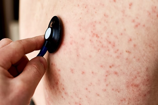 Hà Nội ghi nhận thêm 120 ca mắc sởi