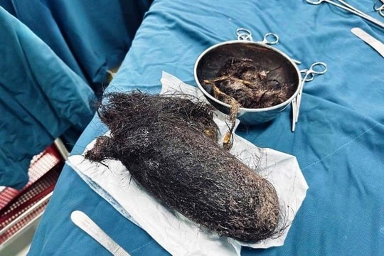 Phẫu thuật lấy búi tóc nặng gần 1kg trong dạ dày bệnh nhi 12 tuổi