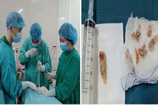 Suýt nguy kịch vì hóc xương gà