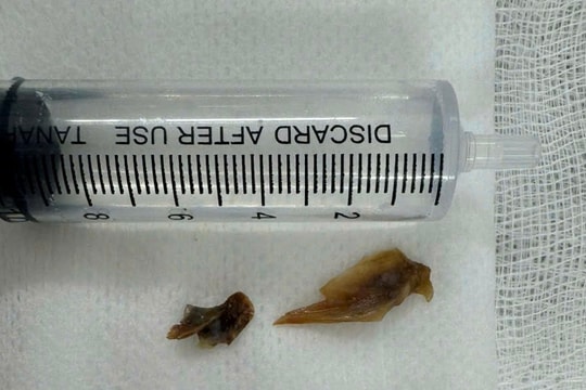 Lấy thành công lấy 2 mảnh xương bị bỏ quên trong phổi