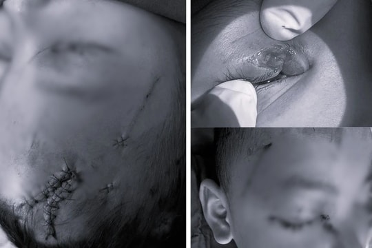 Bé trai nhập viện khẩn cấp vì bị chó cắn