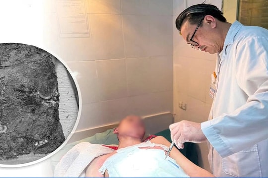 Nam sinh suýt mất mạng vì chữa bỏng sai cách