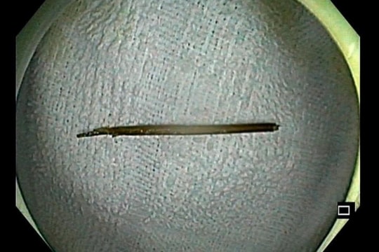 Bị thủng đại tràng vì ngậm tăm khi ngủ