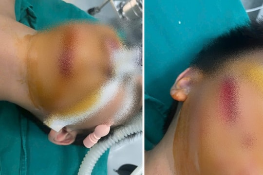 Bé trai bị chó nhà cắn rách mặt