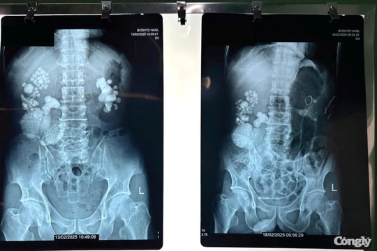 Phẫu thuật lấy hơn 100 viên sỏi trong thận người bệnh