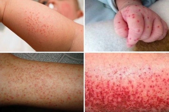 Bộ Y tế: Tăng cường phòng, chống dịch trong giai đoạn giao mùa