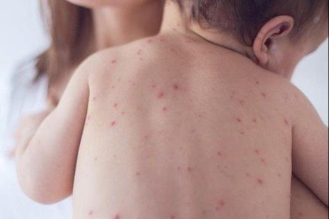 Hà Nội khởi động chiến dịch phòng, chống sởi đợt 3 năm 2025