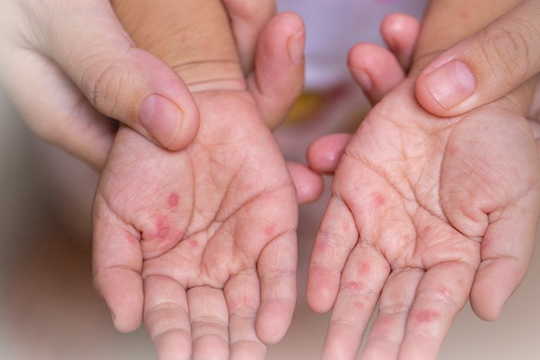 Bệnh tay chân miệng gia tăng, cần cảnh giác và chủ động phòng bệnh cho trẻ