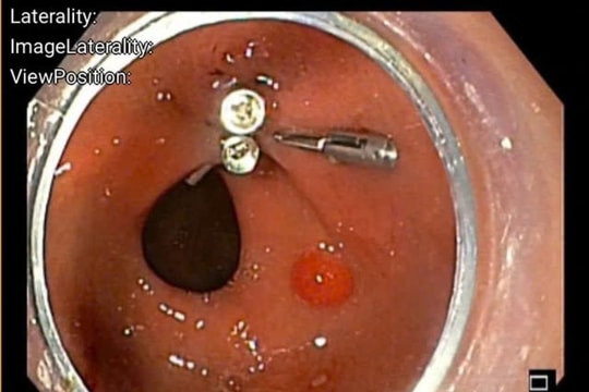 Suýt mất mạng vì xương cá đâm vào dạ dày