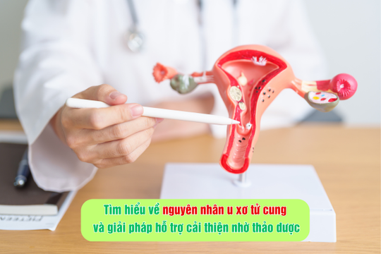 Tìm hiểu về nguyên nhân u xơ tử cung và giải pháp hỗ trợ cải thiện nhờ thảo dược