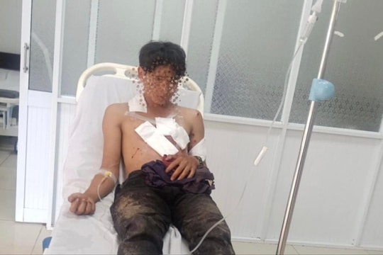 Mìn đánh cá tự chế phát nổ, 2 người thương nặng