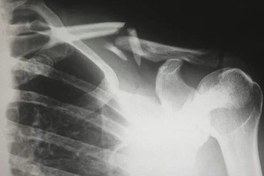 Lạm dụng kem chống nắng, người phụ nữ lăn trên giường cũng gãy xương