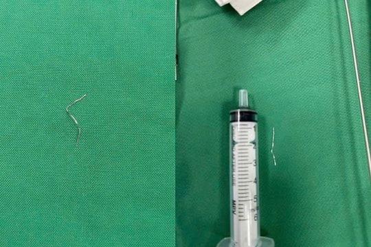 Gắp thành công dị vật kim loại dài 3cm trong lưỡi bé 12 tháng tuổi