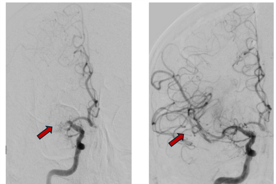 Bệnh viện TP.HCM cứu sống một người Nga đột quỵ nặng