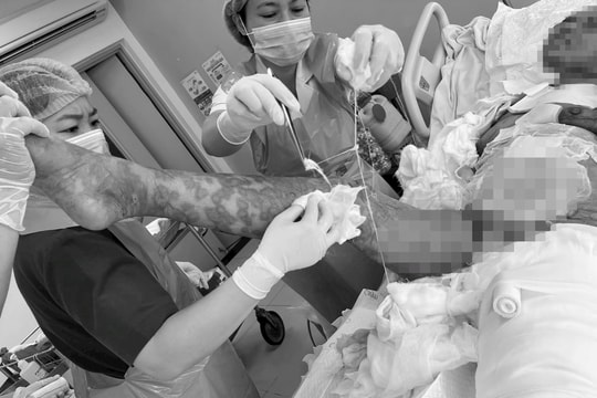 Người phụ nữ mắc hội chứng Lyell, tổn thương da 92%