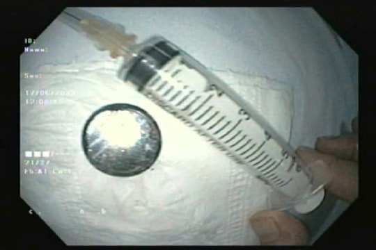 Bé 18 tháng tuổi nuốt pin cúc được cứu sống kịp thời