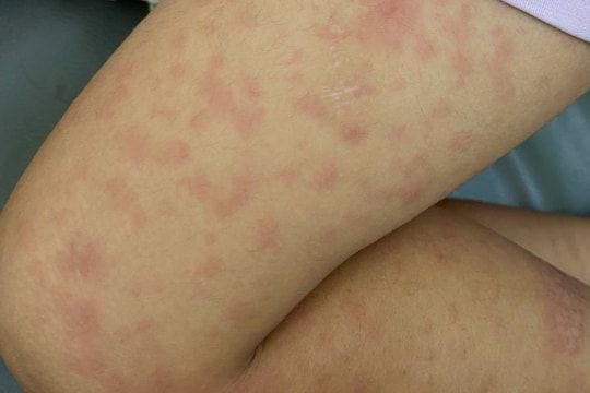 Phần lớn phường, xã, thị trấn ở TP.HCM đã công bố hết dịch sởi