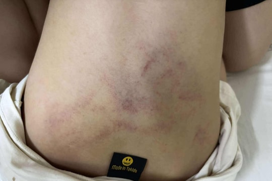 Bé mầm non bị giáo viên bạo hành tại trường ở Hà Nội