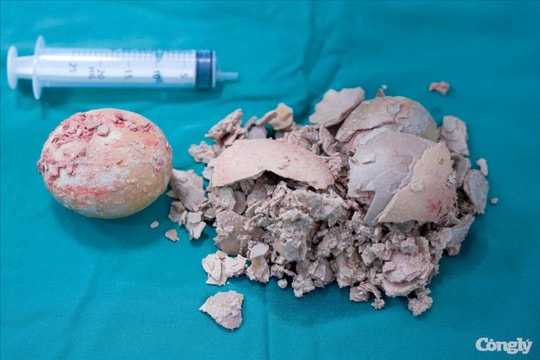 Viên sỏi “khổng lồ hơn 10cm” được lấy ra từ nữ bệnh nhân