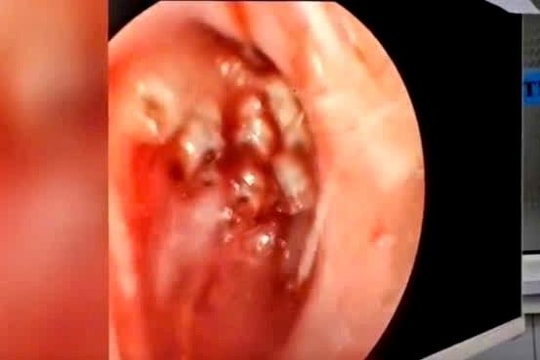 Dòi đóng ổ trong hốc mũi người phụ nữ