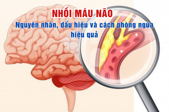 Nhồi máu não: Nguyên nhân, dấu hiệu và cách phòng ngừa hiệu quả