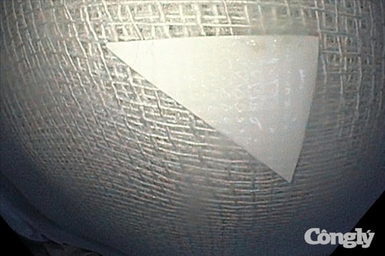 Cấp cứu bé gái 7 tháng tuổi nuốt vỏ thuốc có cạnh sắc, nhọn, ho kèm theo máu