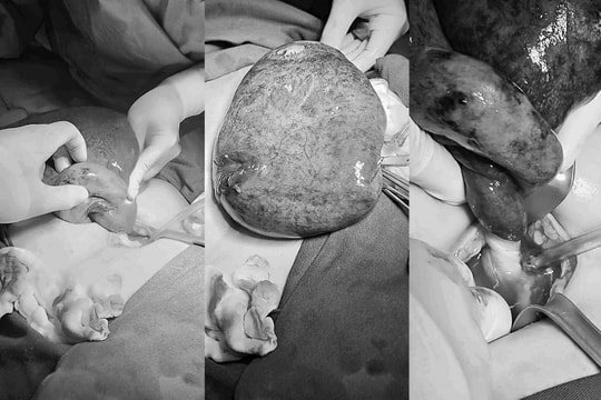 Bóc khối u buồng trứng 25cm, bảo toàn khả năng sinh sản cho bé gái 15 tuổi