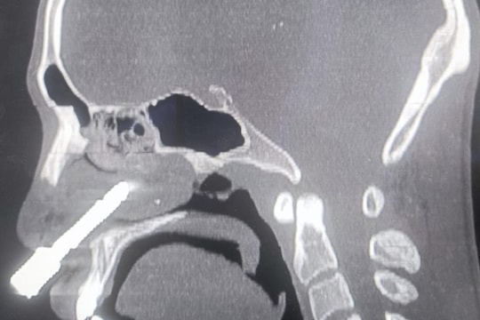 Hy hữu: Nam nhanh niên bị mũi khoan đá đâm xuyên hốc mũi