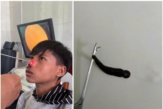Con đỉa dài 4cm trong mũi một bệnh nhi