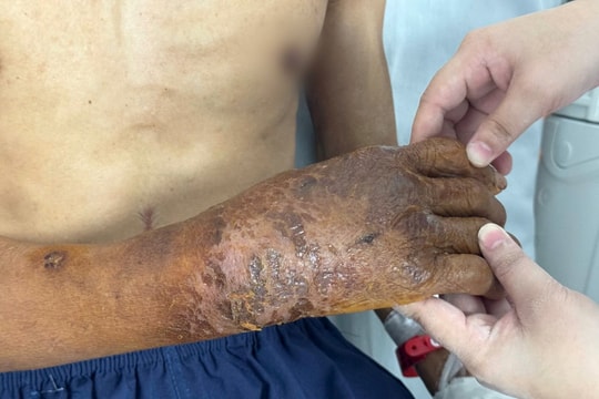 Nguy kịch vì chủ quan không tiêm phòng uốn ván sau chấn thương