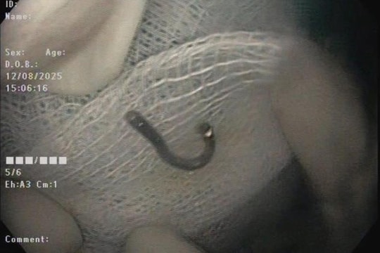 Bé 5 tuổi nhập viện vì nuốt móc cài vòng đeo tay