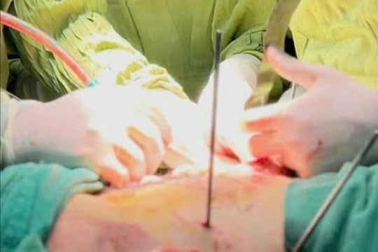 Người đàn ông bị đứt nửa phần bụng đã xuất viện