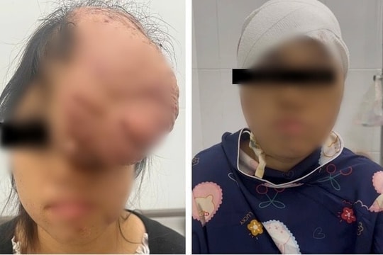 7 giờ loại bỏ khối u sụn xương sọ khổng lồ cho một bệnh nhân nữ
