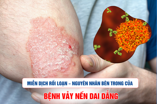 Rối loạn miễn dịch – Căn nguyên khiến vảy nến dai dẳng