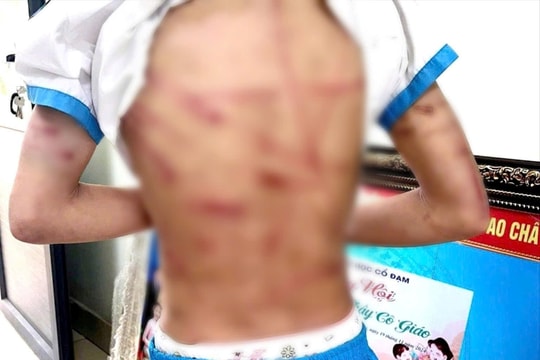 Bé gái trên người chi chít vết thương nghi bị bạo hành