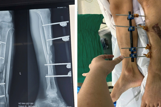 Kỳ tích tái tạo xương chày bằng vi phẫu cho bệnh nhân