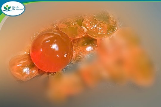 Bé trai 14 tháng tuổi phải mổ cấp cứu vì nuốt hạt nở