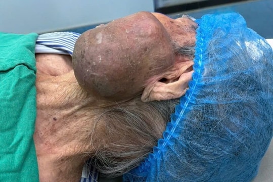 Cụ bà 99 tuổi trút được khối u “đày đọa” trên mặt