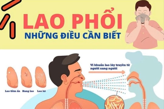 Tăng cường phòng, chống bệnh lao, hướng đến mục tiêu chấm dứt vào năm 2030